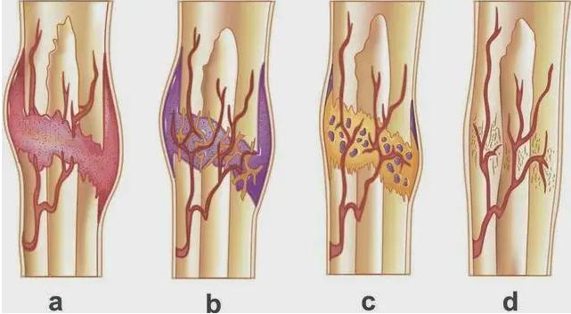 骨折后饮食的注意事项和调理,骨折后如何饮食促进骨折的愈合