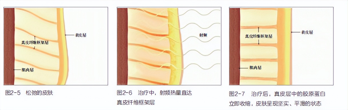 做热玛吉紧肤除皱多少钱,热玛吉紧肤祛皱需要多少钱