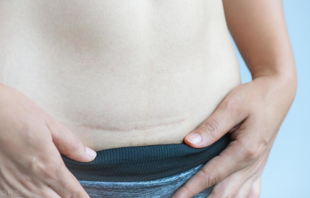 增生性疤痕如何治疗,肥厚性瘢痕怎么治疗有效果