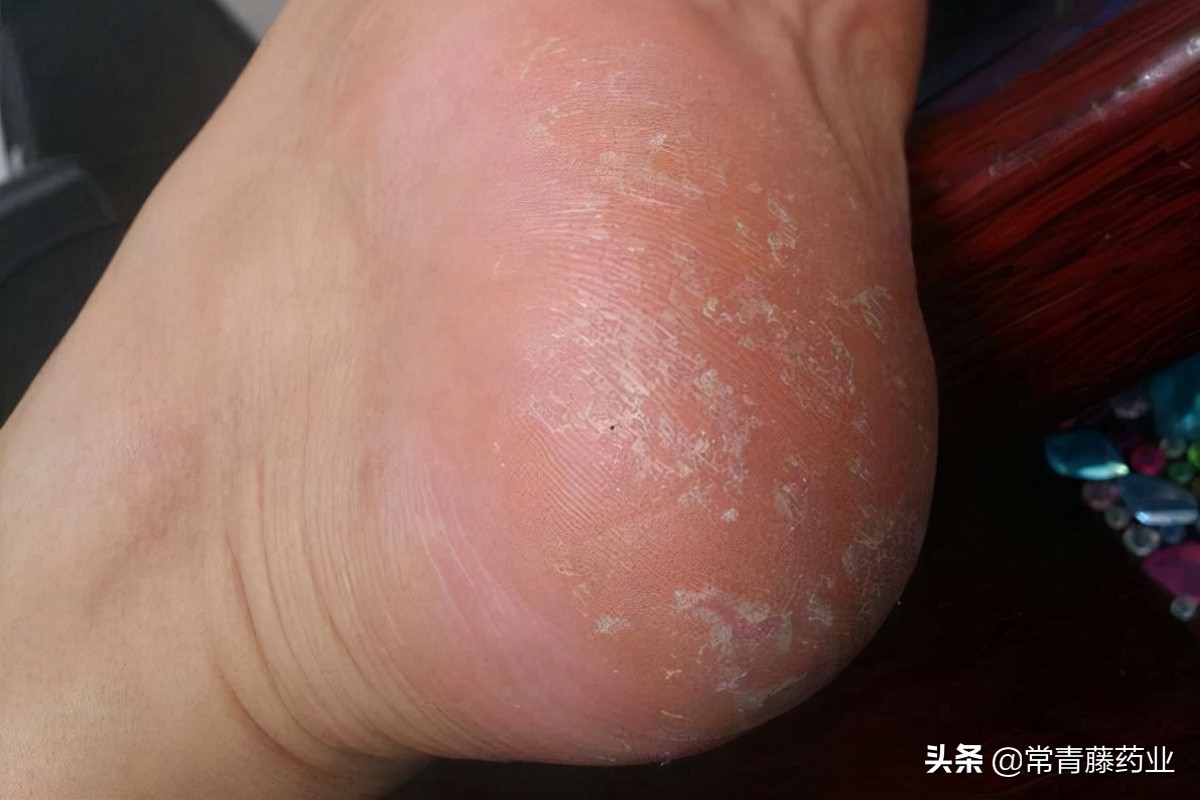 走路时脚底总是压着硬块，又肿又疼，是鸡眼还是病毒疣？