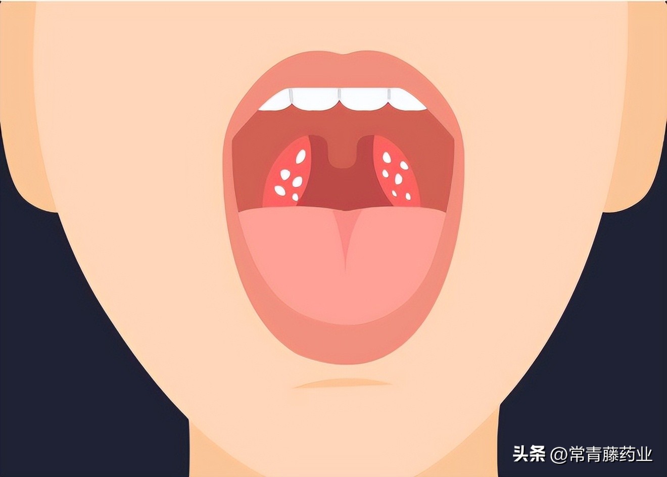 咳出来黄色的小颗粒是什么,嘴里咳出来的小黄粒是什么