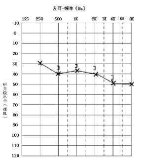 突发性耳聋的病因是什么,突发性耳聋的病因及发病机制