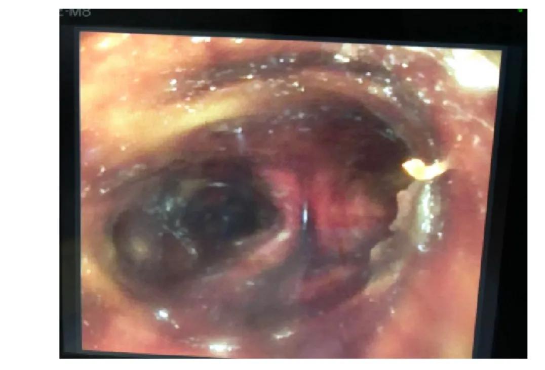 柴油吸入肺部感染怎么治疗好得快,吸柴油的时候呛到肺里了怎么办