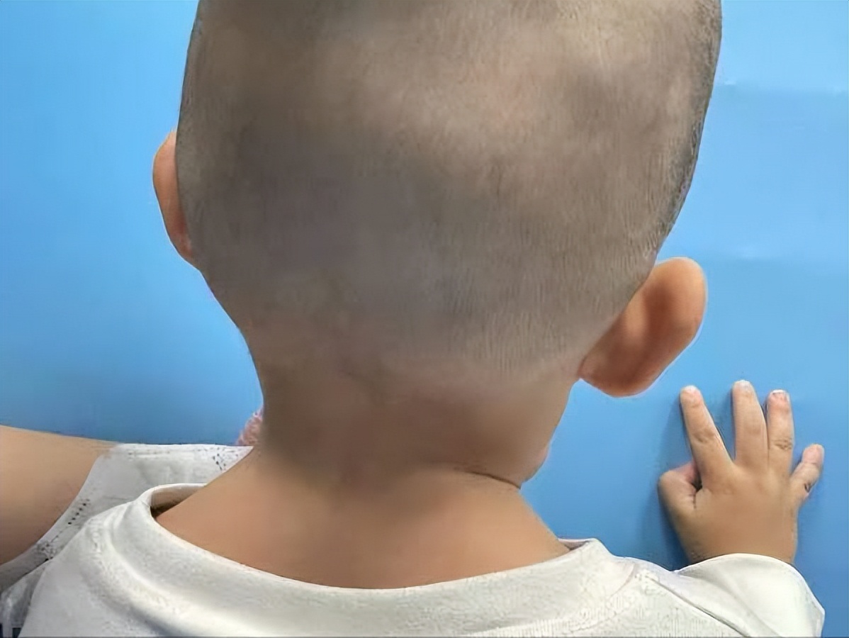 儿童耳后淋巴结中医治疗方法,小孩耳后长了一个淋巴管瘤