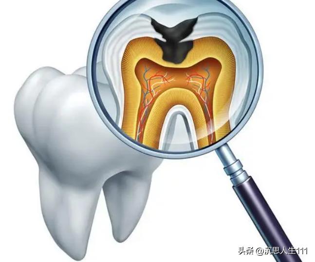 龋齿的形成原因和过程动画,龋齿发生机制的图片