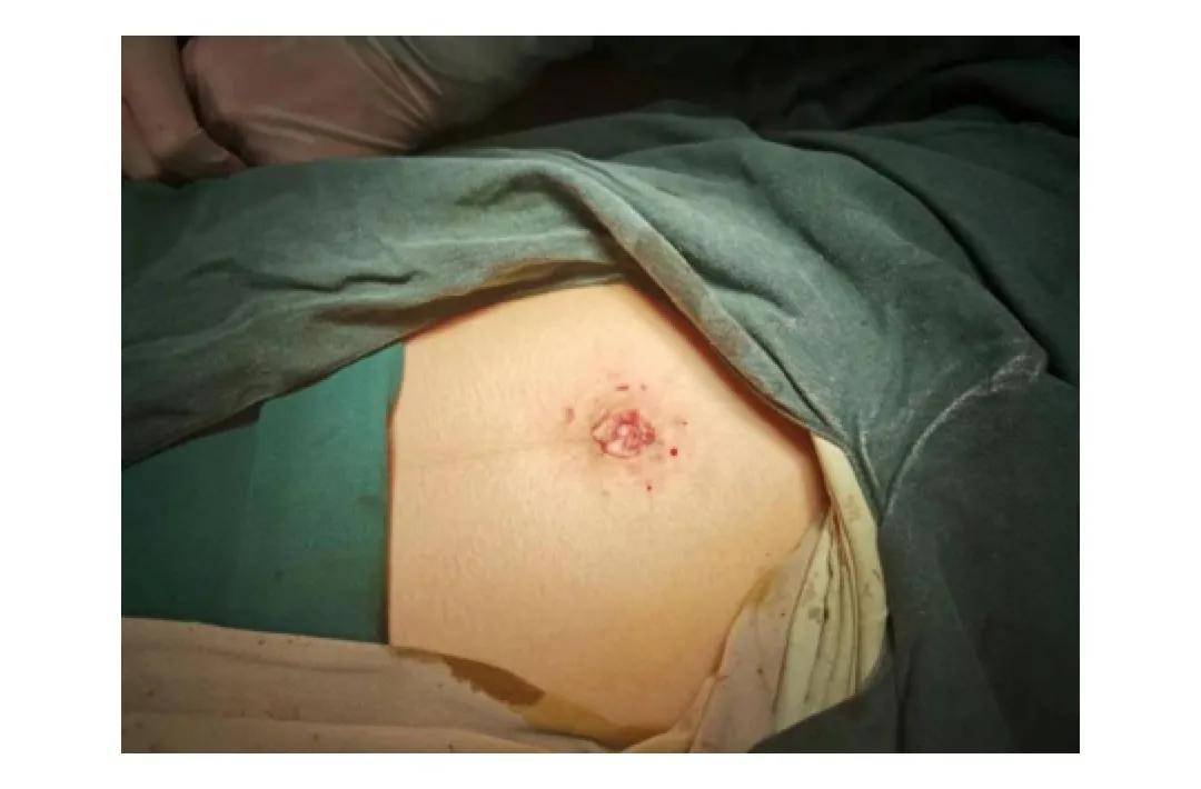 单孔腹腔镜的技术优势有哪些,有关妇科单孔腹腔镜手术的科普