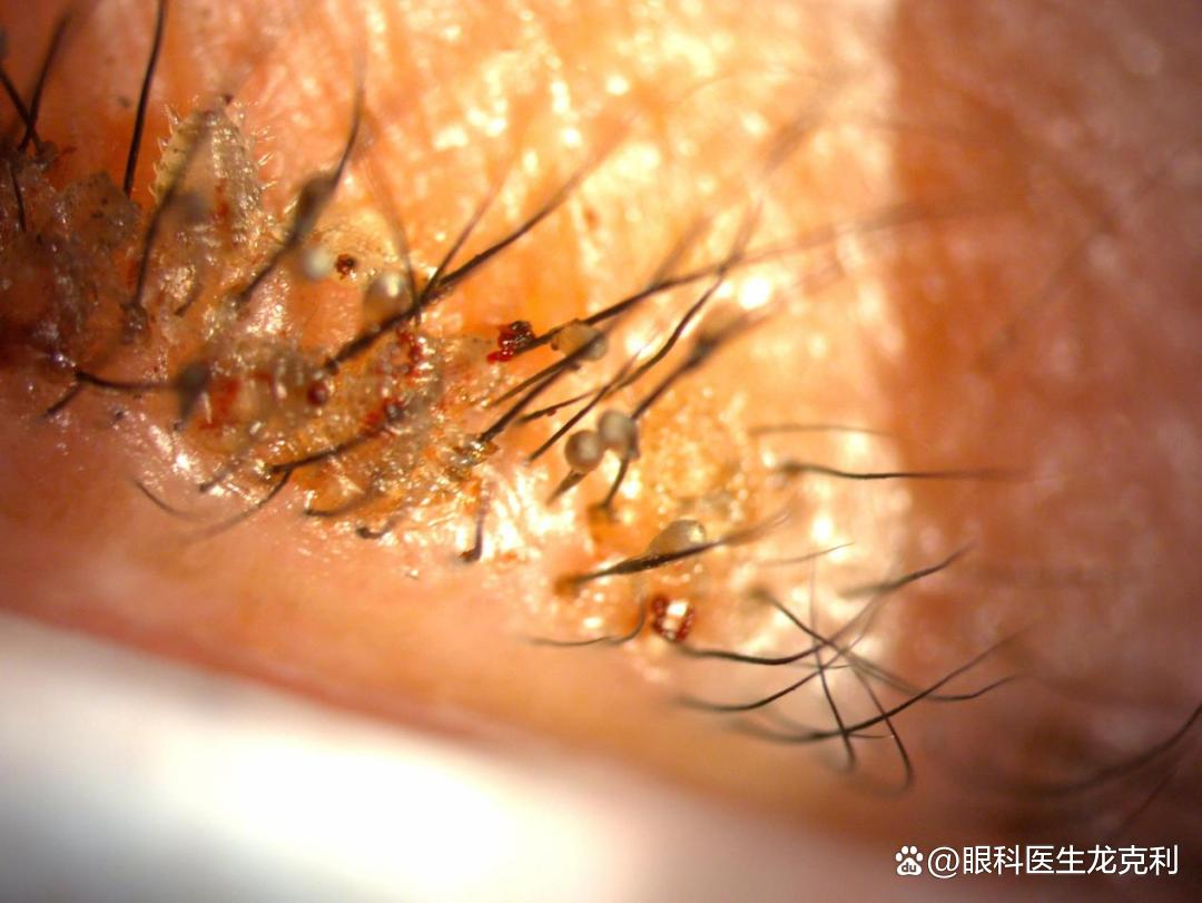 眼睛会看到虫子是什么原因,眼睛里面有虫子的特征