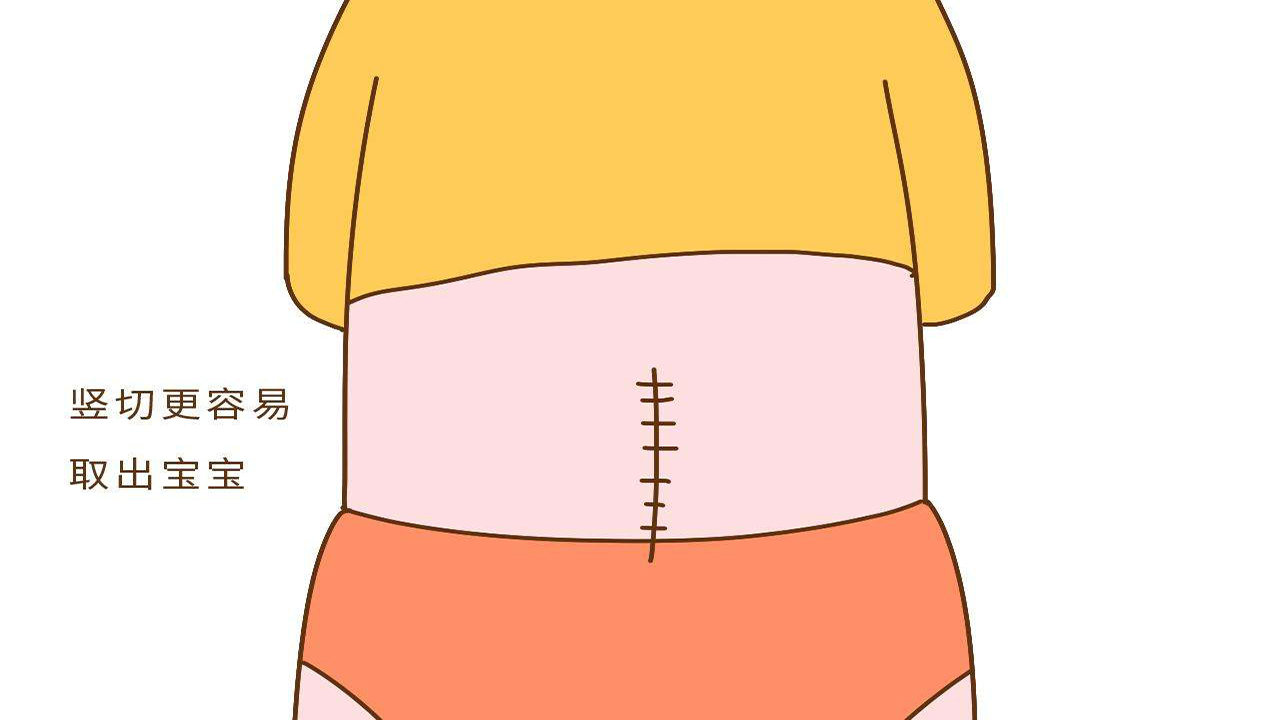 顺产vs剖宫产到底哪个好,剖宫产和顺产哪个好得快