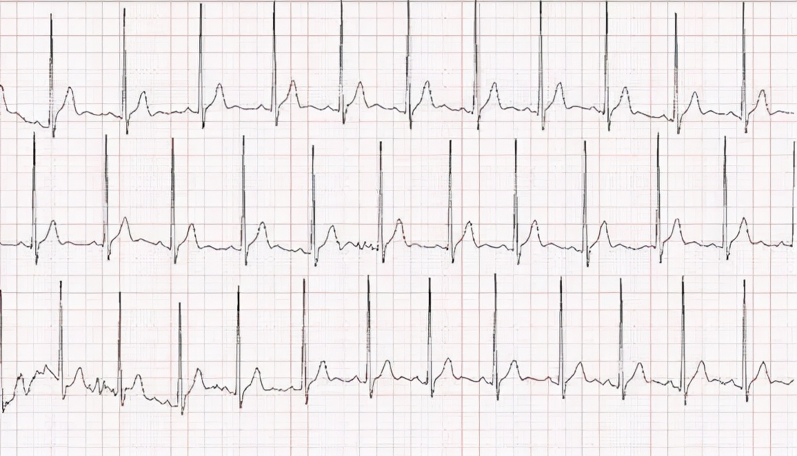 男子酒后喉咙痛到医院一查心梗,胸痛去医院做心电图正常