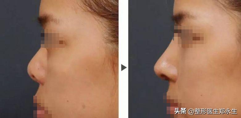 女子花7000去美容不料整成红鼻子,美容整鼻子事件