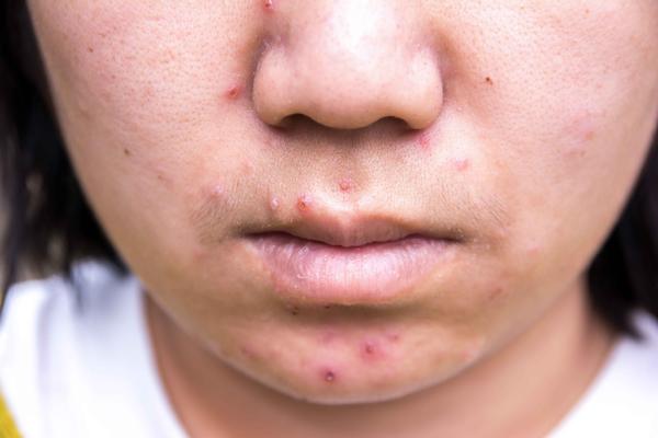 什么原因会引起头发毛囊炎,毛囊炎为什么如此反复难治