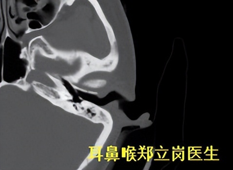 慢性中耳炎耳膜穿孔灌脓了怎么治,中耳炎引起鼓膜炎怎么办