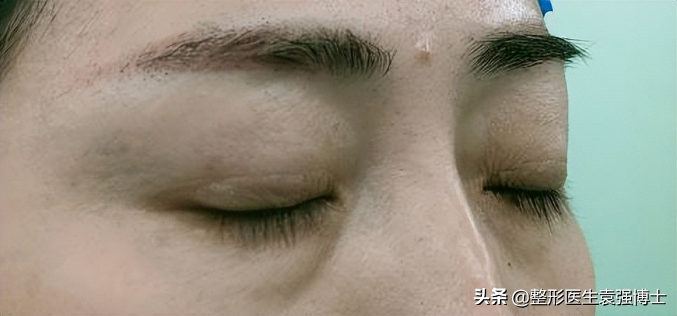 眼周年轻化手术效果可以持续多久,眼周医美项目