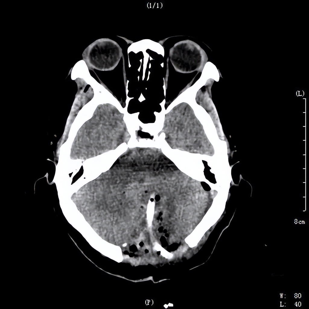 送医时间决定治疗效果！六旬老人突发脑出血送医及时恢复良好