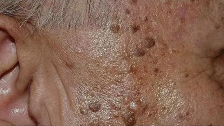 老人长老年斑是什么原因引起,老年人脚底长老年斑是怎么回事