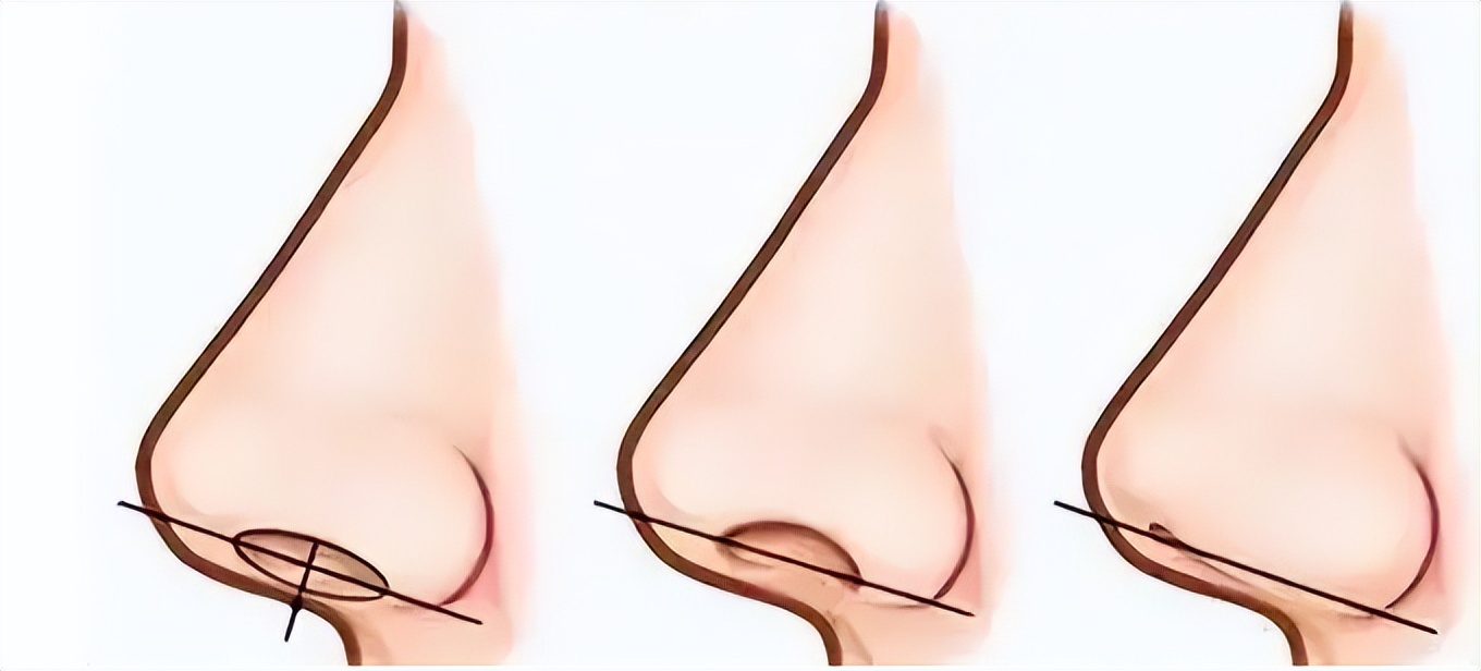 上海九院韦敏轮廓做得好吗,上海九院韦敏鼻子做得好吗