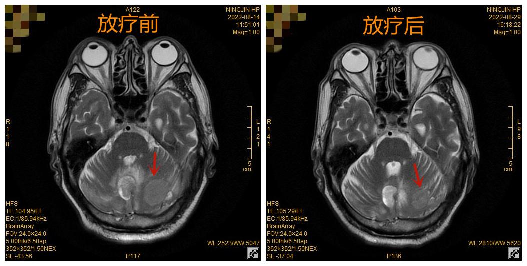 放疗治疗颈部癌症的效果,放疗根治食管癌