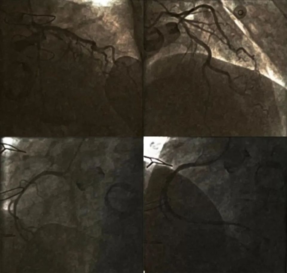 瓣膜置换术后心率快怎么办,瓣膜置换后如何预防心梗