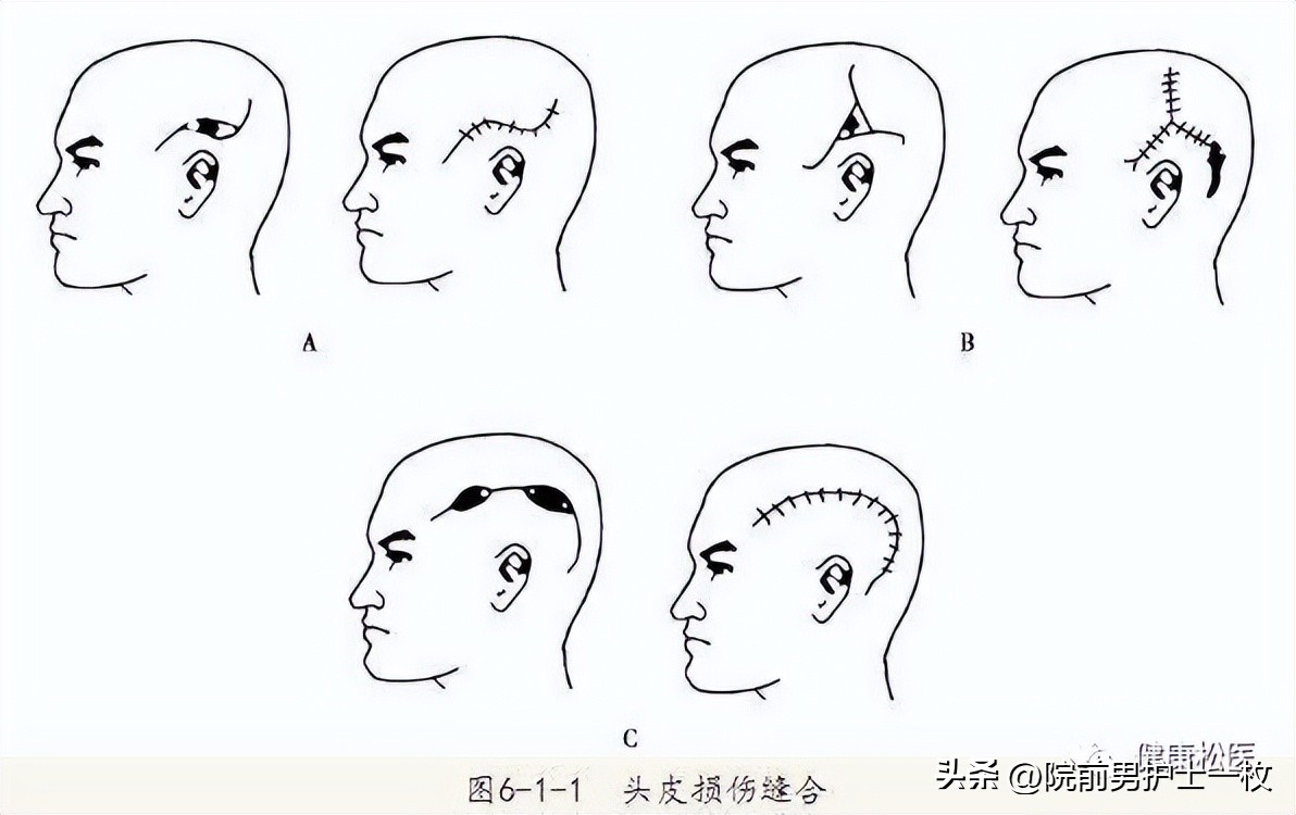 重型颅脑外伤患者急救护理措施,颅脑外伤病人的应急处理