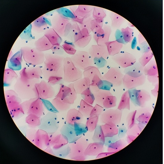 tct手机上可看到报告吗,妇科tct报告如何解读