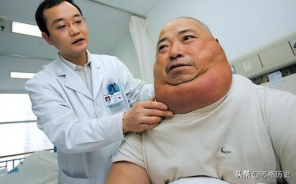 喝了40年酒结果变成河马脖,喝白酒脖子变成河马脖