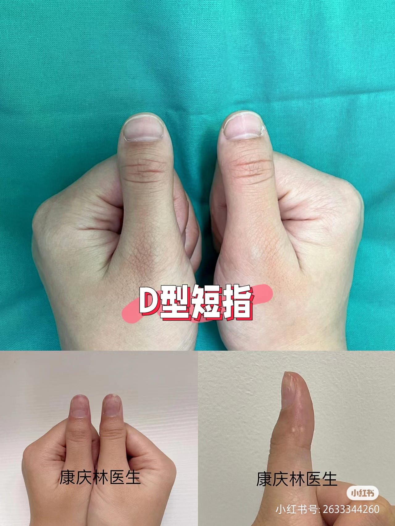 手指的小指很短是怎么回事,小拇指短是什么型短指症