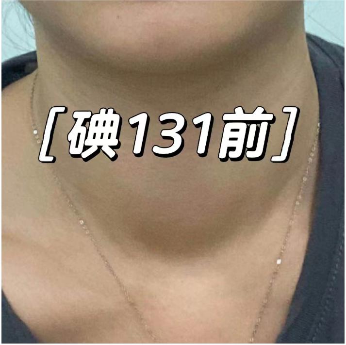 碘131治疗患者自述,甲亢患者治愈分享
