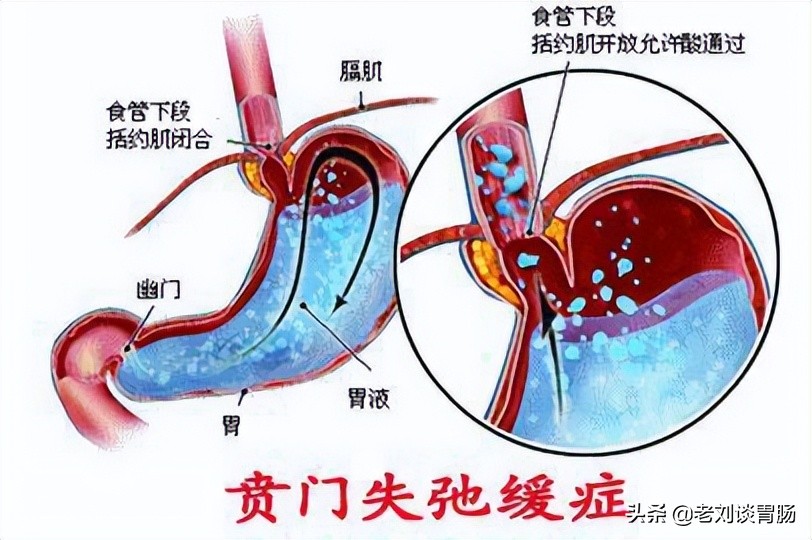 贲门失弛缓症什么引起的,贲门失弛缓症是什么原因引起的
