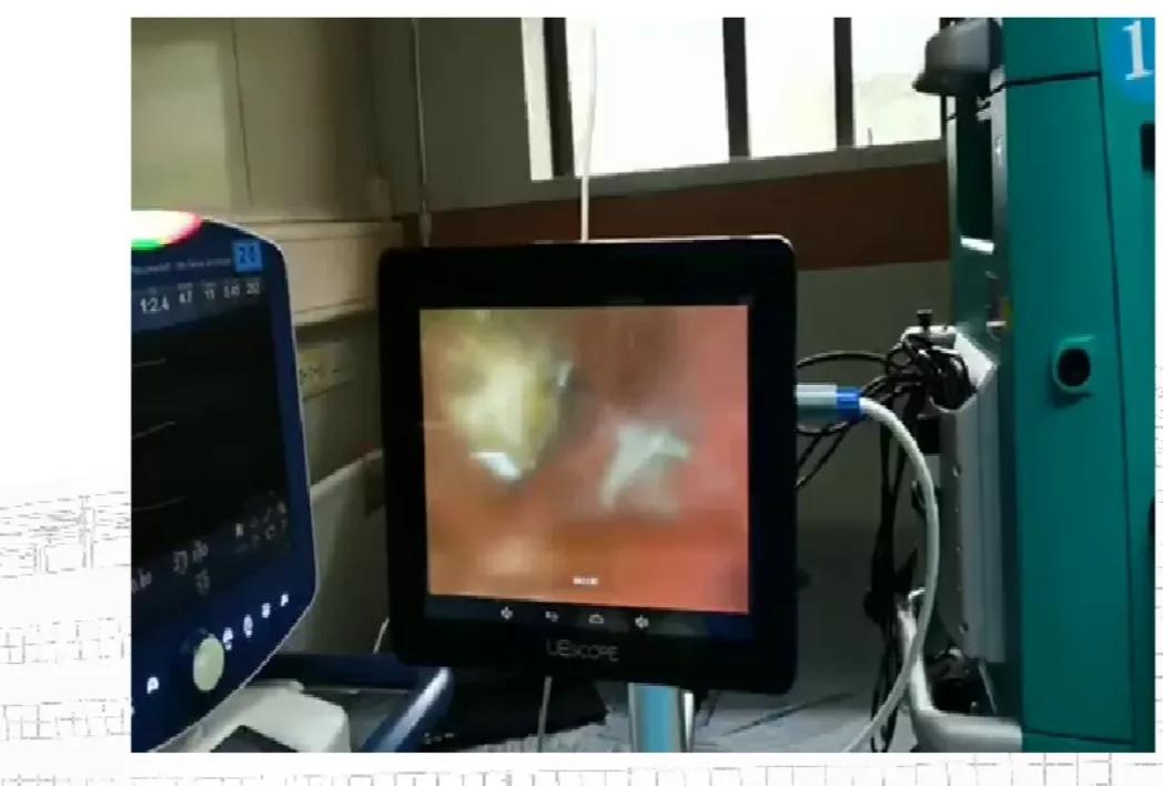 柴油吸入肺部感染怎么治疗好得快,吸柴油的时候呛到肺里了怎么办