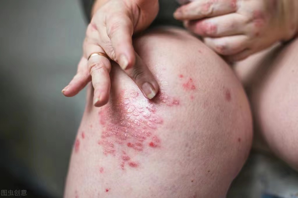 涂了药膏牛皮癣会根治吗,患有牛皮癣身上抓破很难好