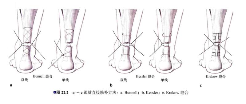 运动员跟腱断裂能恢复到100%吗,足球运动员跟腱断裂影响大吗