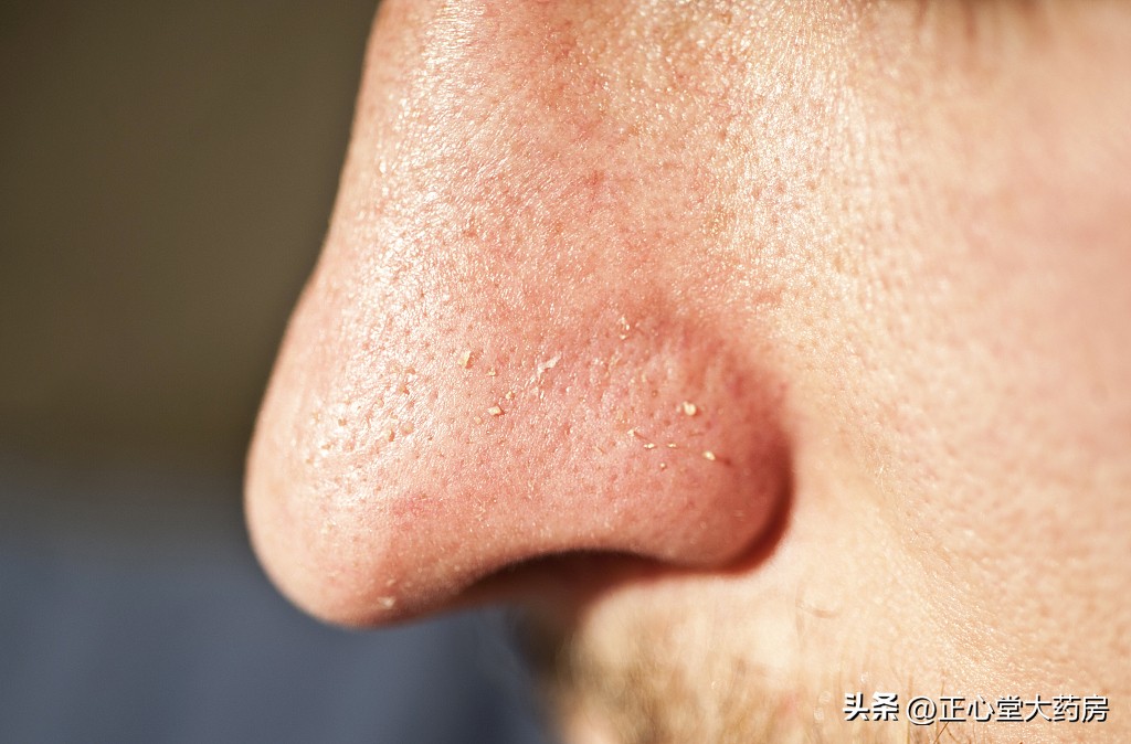 鼻子脸颊容易出油怎么护肤,鼻子老是爱出油用什么护肤