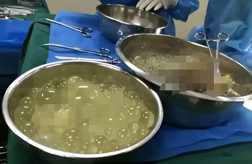 小男孩患虫癌,7岁男孩患虫癌