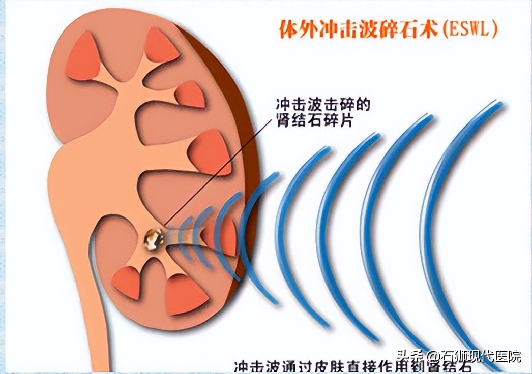 输尿管结石一直痛说明是在下滑吗,痛得要死的结石