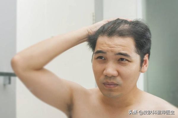 脱发头发出油原因有三种,头皮干了会脱发还是油了会脱发