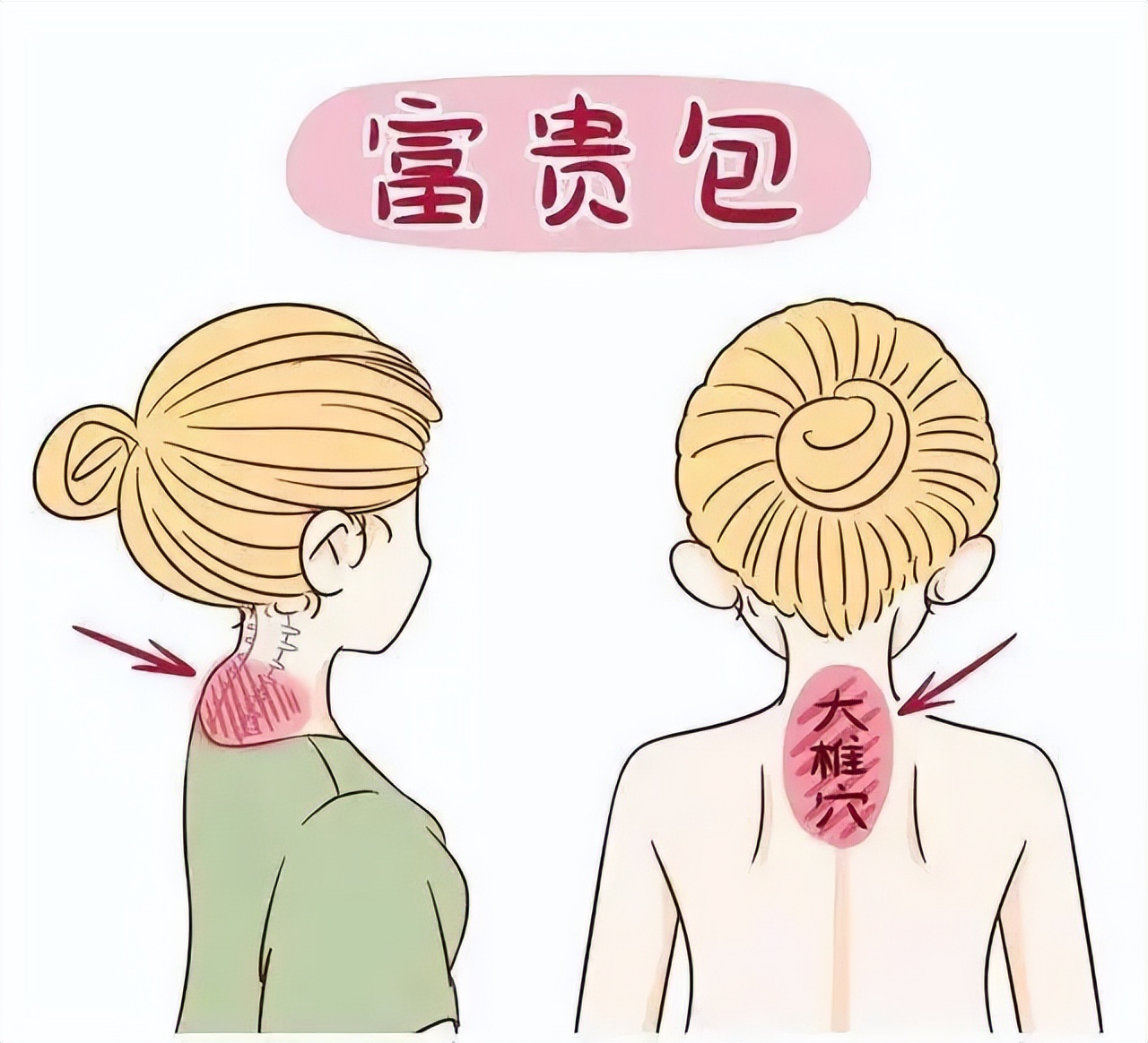 富贵包怎么改善,富贵包手法矫正视频