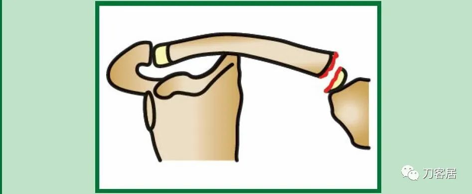 儿童锁骨骨折保守治疗的弊端,锁骨粉碎骨折错位不处理会愈合吗
