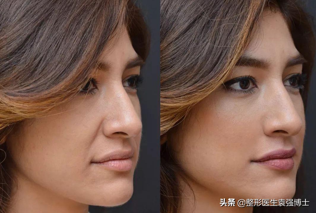 新手医生做拉皮手术可靠吗,北京八大处拉皮手术费多少钱