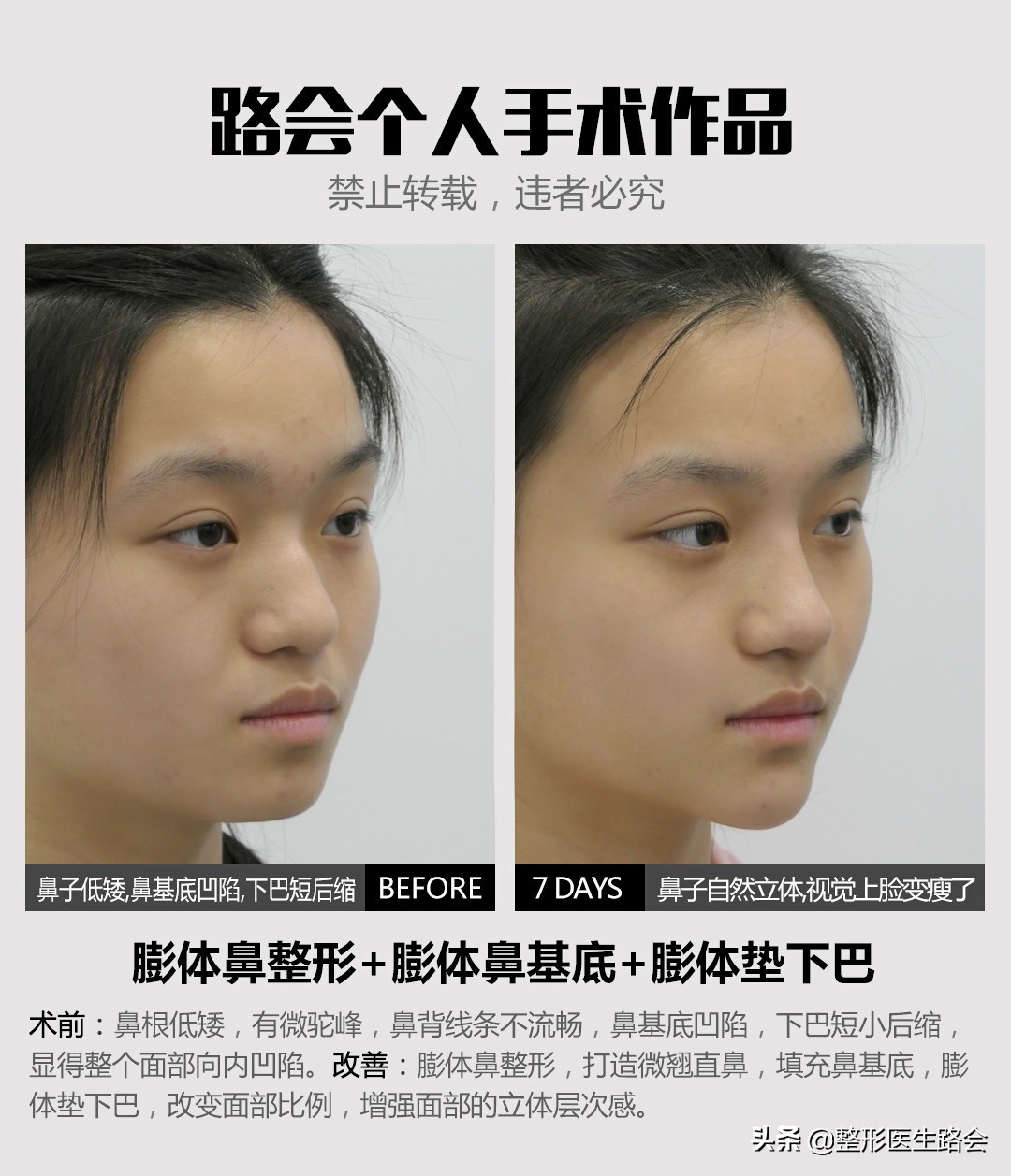 三甲医院鼻整形医生,鼻子整形医生科普类视频