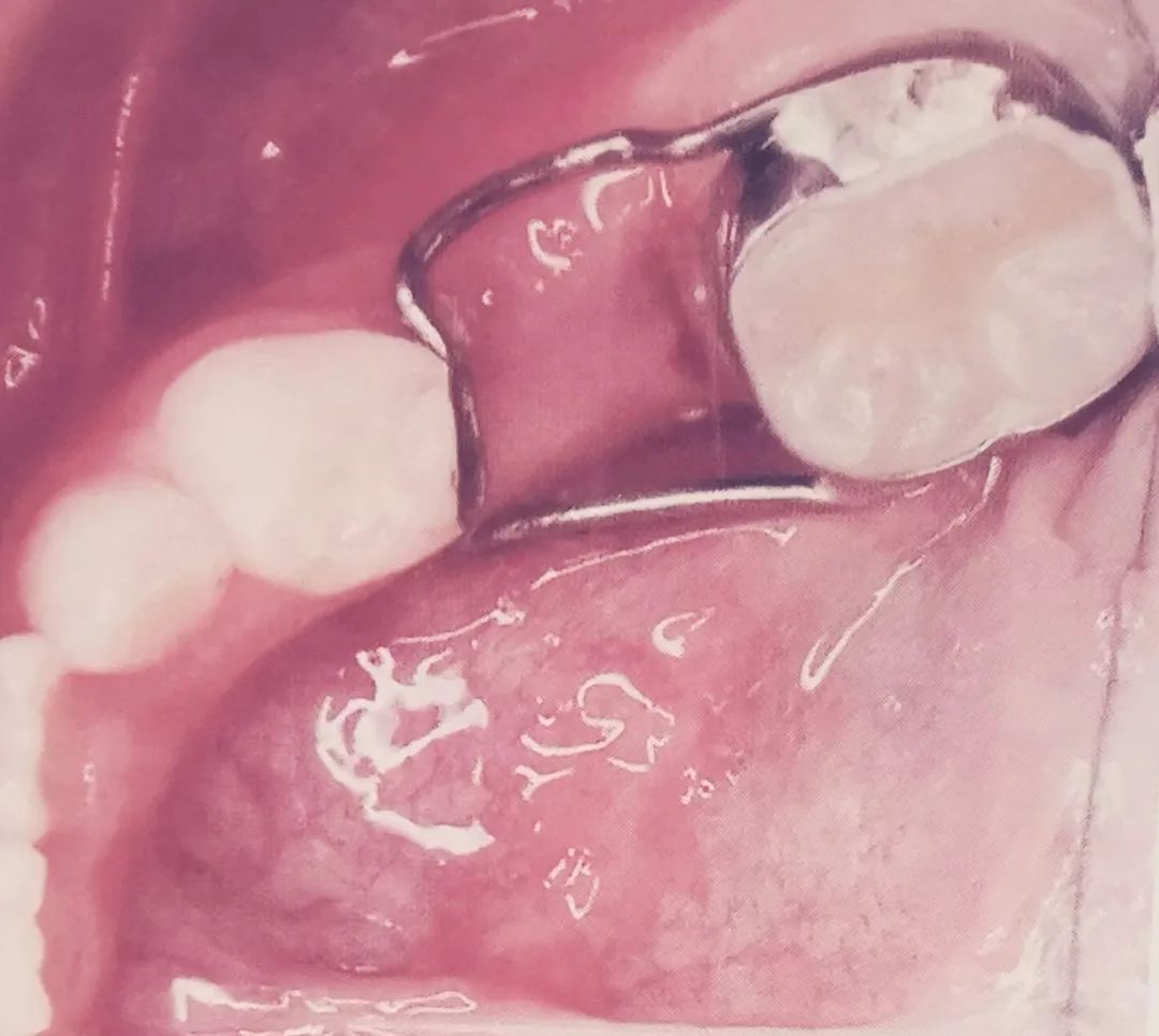 小孩乳牙开始有点松动要怎么办,乳牙发育不良有什么补救的方法