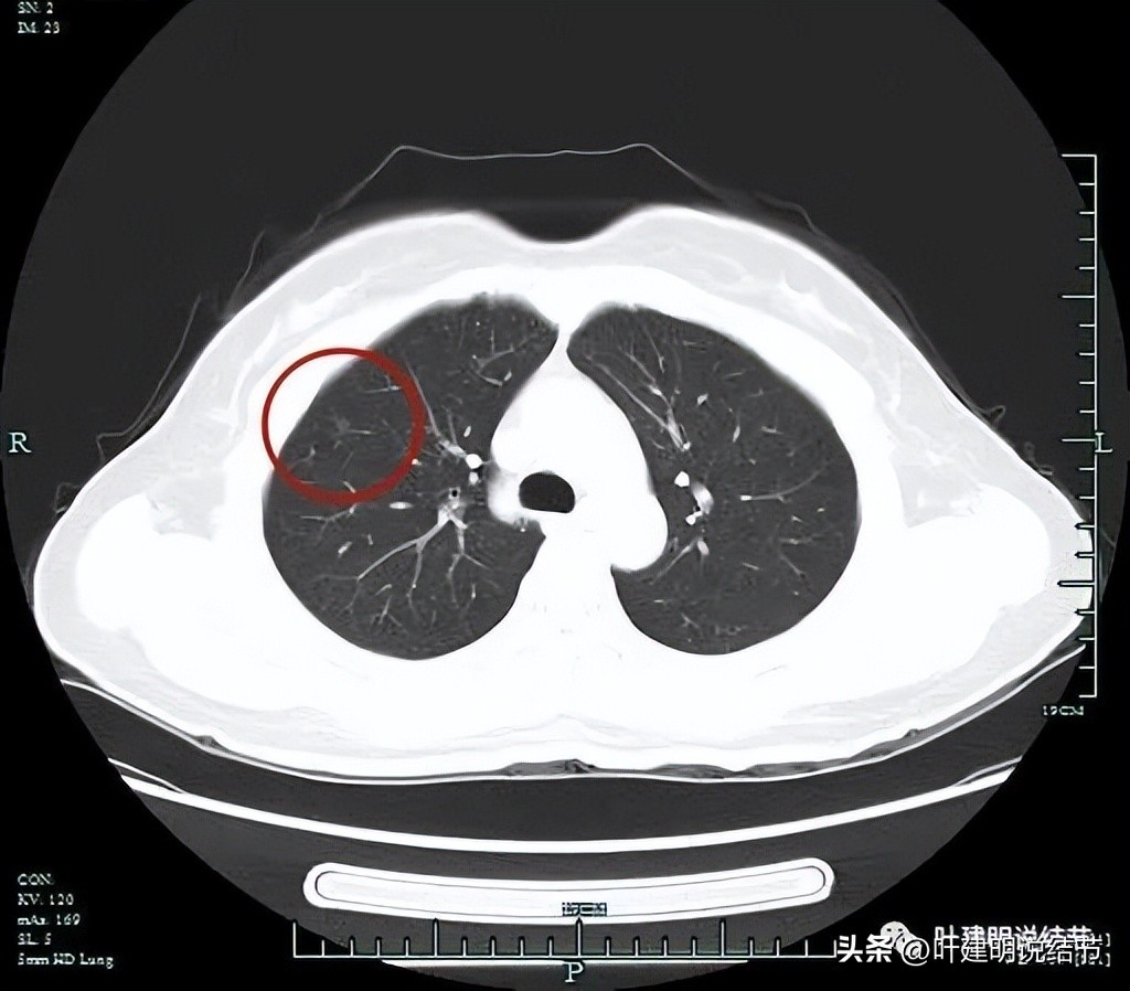 磨玻璃结节伴有增生是癌症吗,磨玻璃结节会是别的癌转移的吗