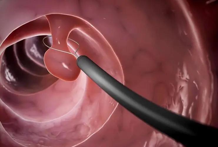 做肠镜没有拉干净灌肠有用吗,做肠镜没有排空怎么办