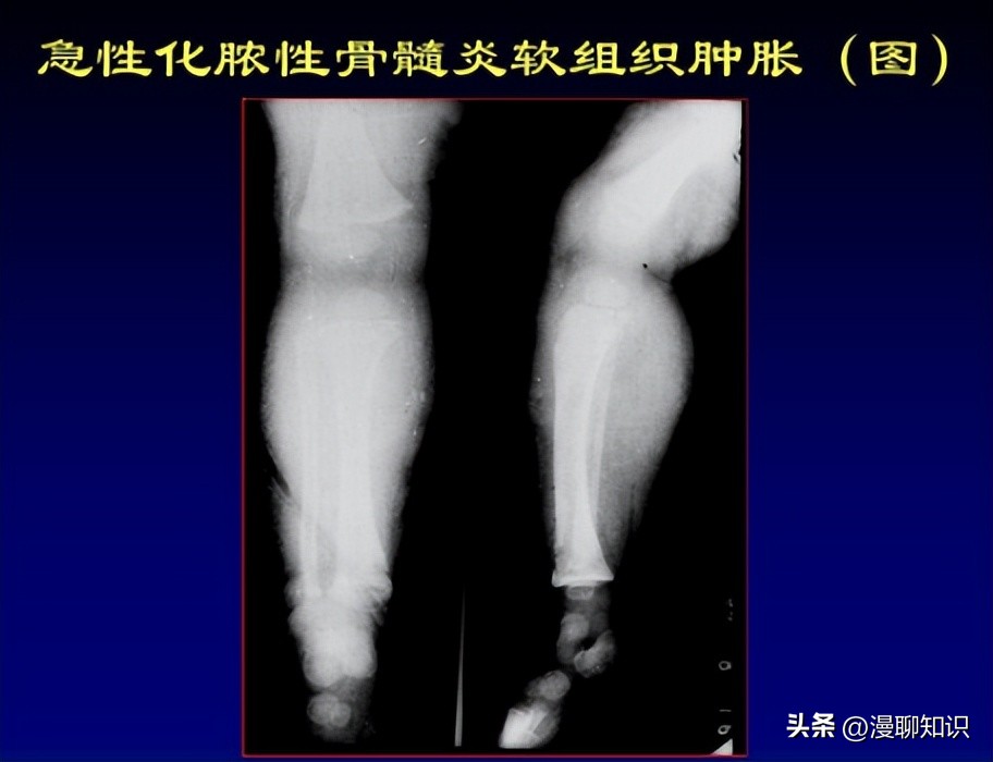 慢性复发性骨髓炎儿童案例,青少年得慢性骨髓炎能治好吗