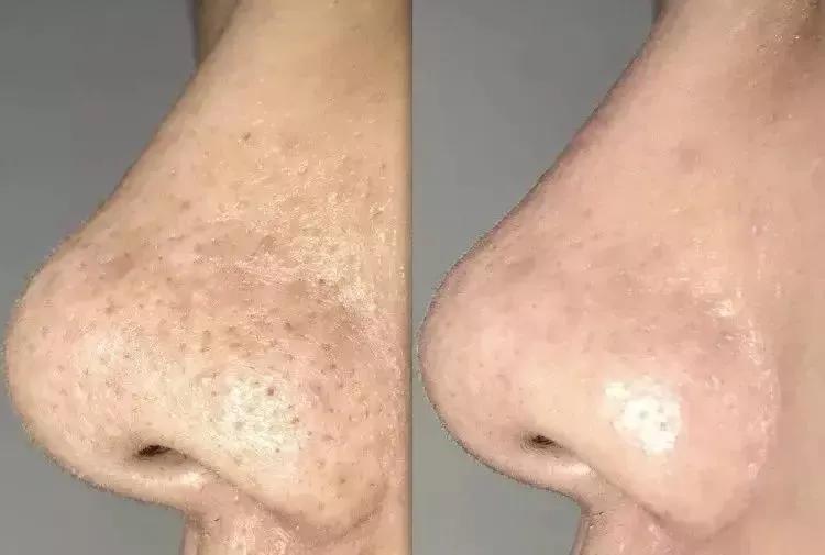 orginese水杨酸清洁泥膜,geoskincare清洁泥膜