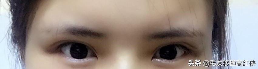 男人眉毛稀疏就要植眉,眉毛稀疏怎么植眉