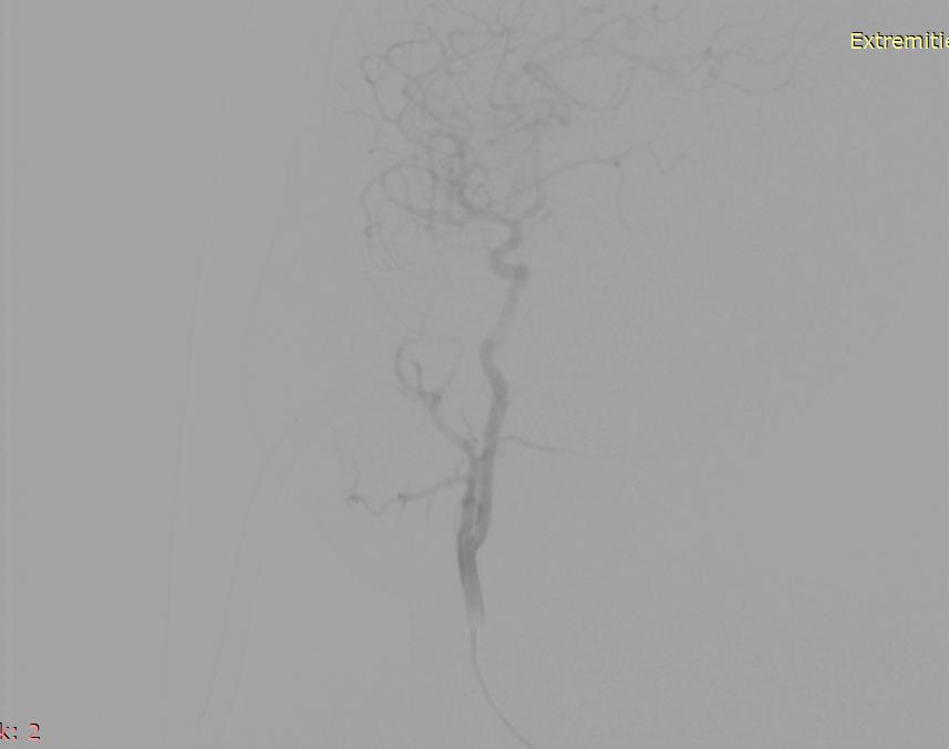 唇血管瘤,嘴唇血管瘤介入治疗过程