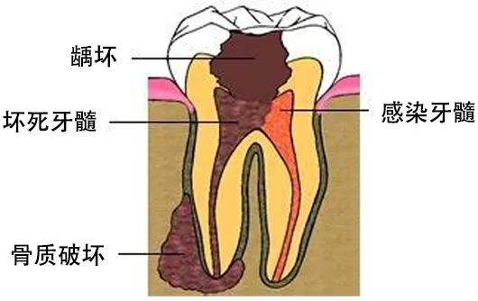 可复性牙髓炎的症状是怎样的,蛀牙引起的牙髓炎有什么症状