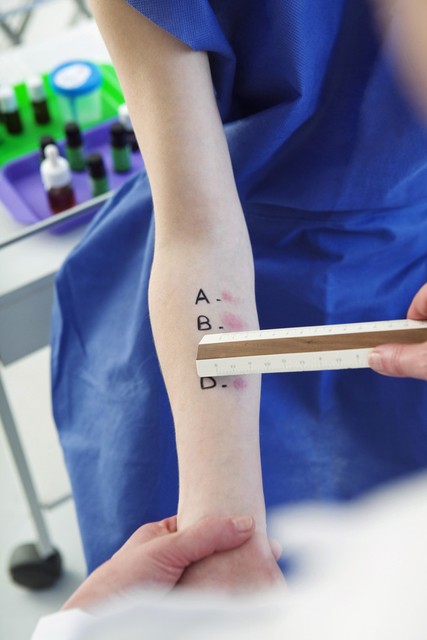 麻疹会引起疼痛么,荨麻疹得了很痛苦吗