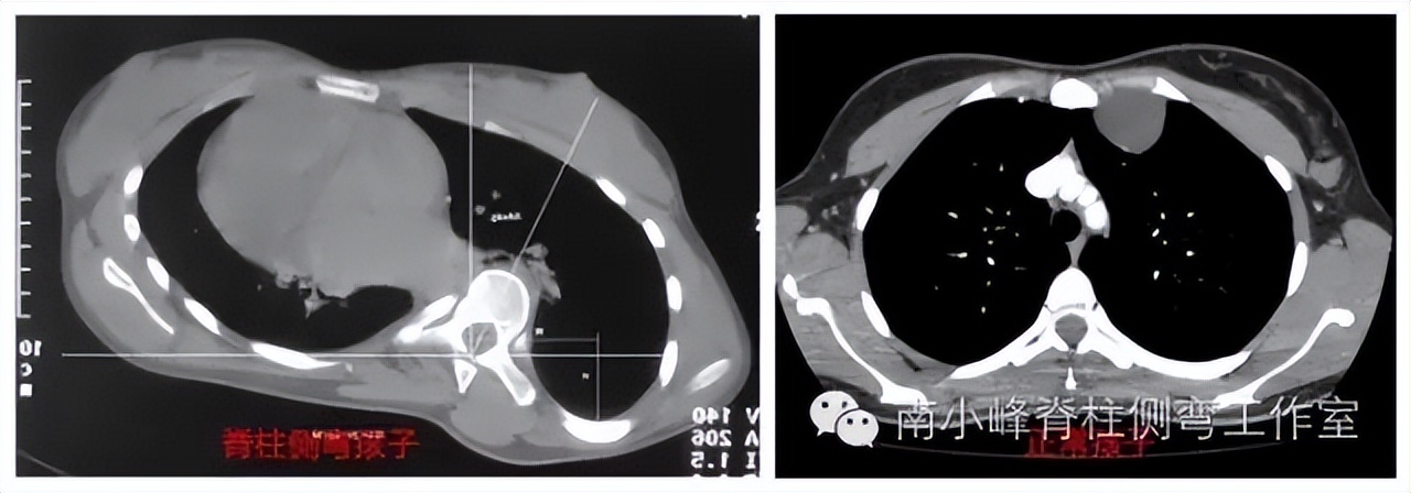 脊柱侧弯出现剃刀背必须手术吗,儿童脊柱侧弯正确的矫正方法