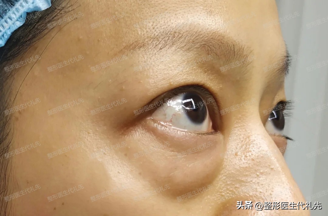眼袋手术52天,眼袋手术27天了还用抹祛疤膏吗
